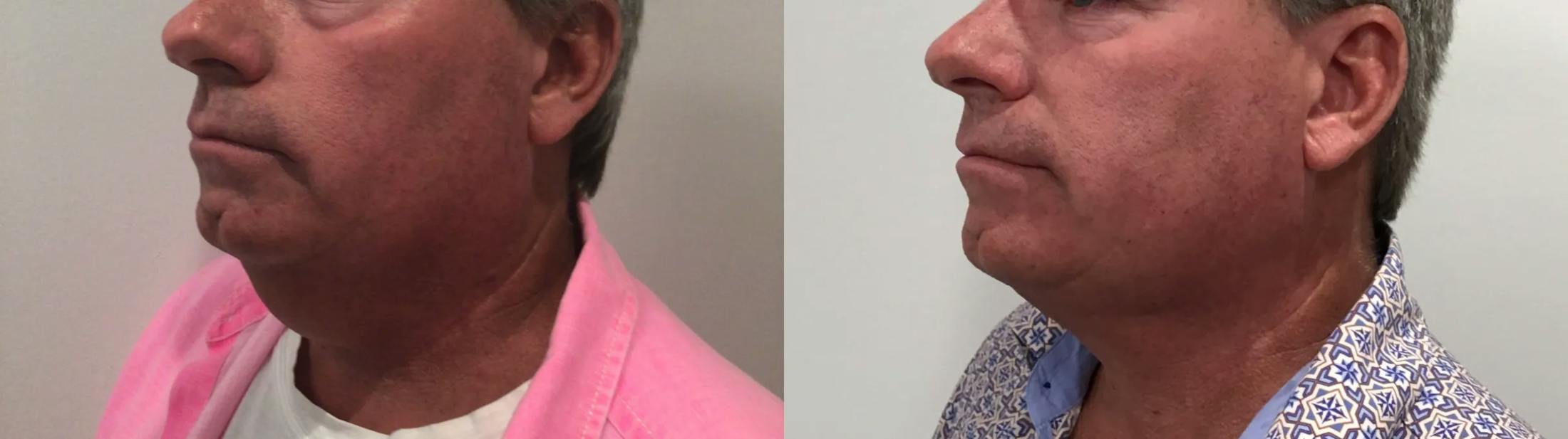 Liposuction Before & After Gallery - Patient 258300 - Image 4