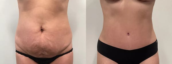 Liposuction Before & After Gallery - Patient 168451 - Image 1
