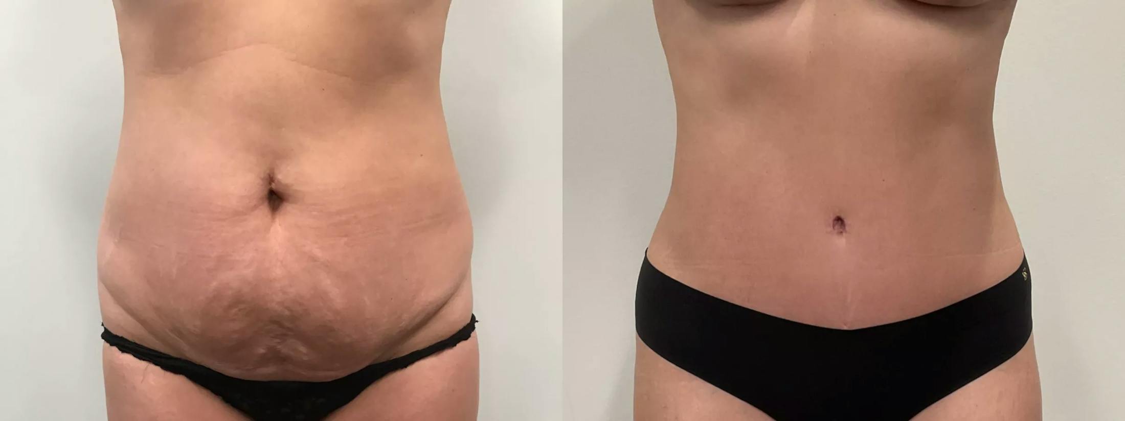 Liposuction Before & After Gallery - Patient 168451 - Image 1