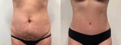 Liposuction Before & After Gallery - Patient 168451 - Image 1