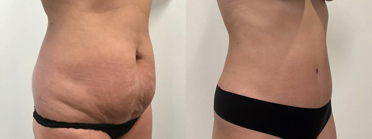 Liposuction Before & After Gallery - Patient 168451 - Image 2