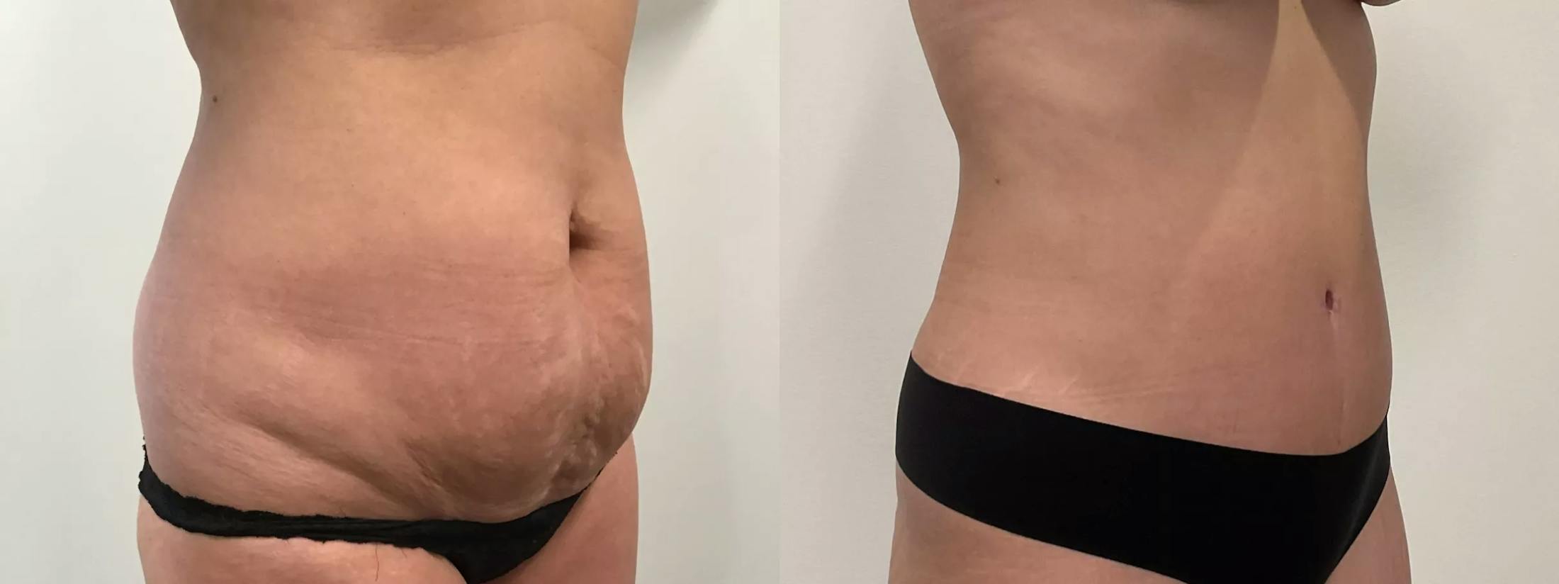 Liposuction Before & After Gallery - Patient 168451 - Image 2