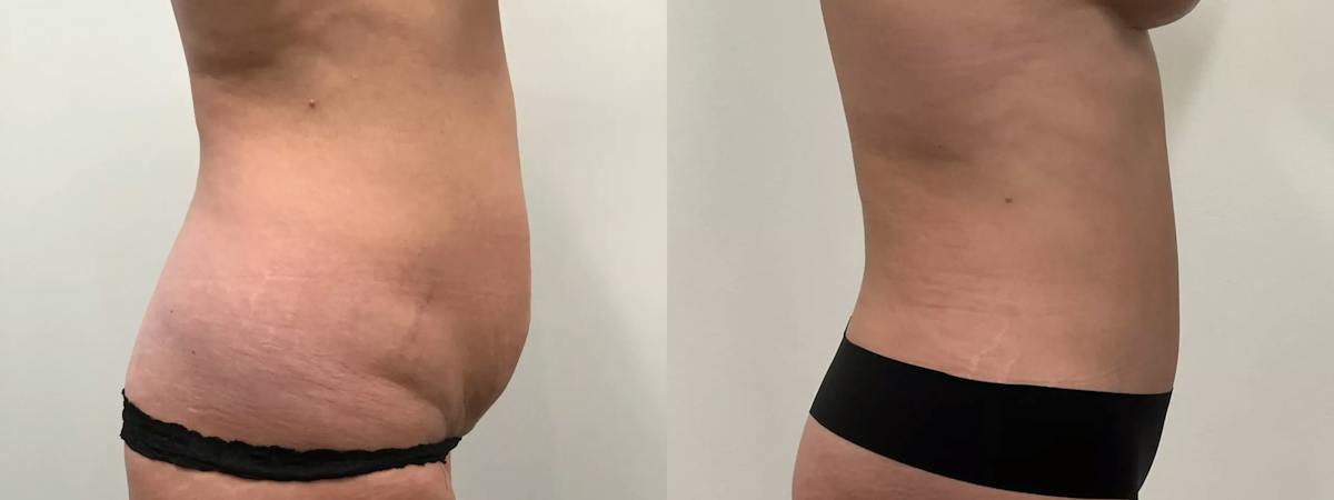 Liposuction Before & After Gallery - Patient 168451 - Image 3