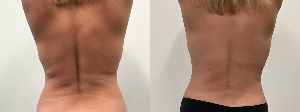 Liposuction Before & After Gallery - Patient 168451 - Image 4