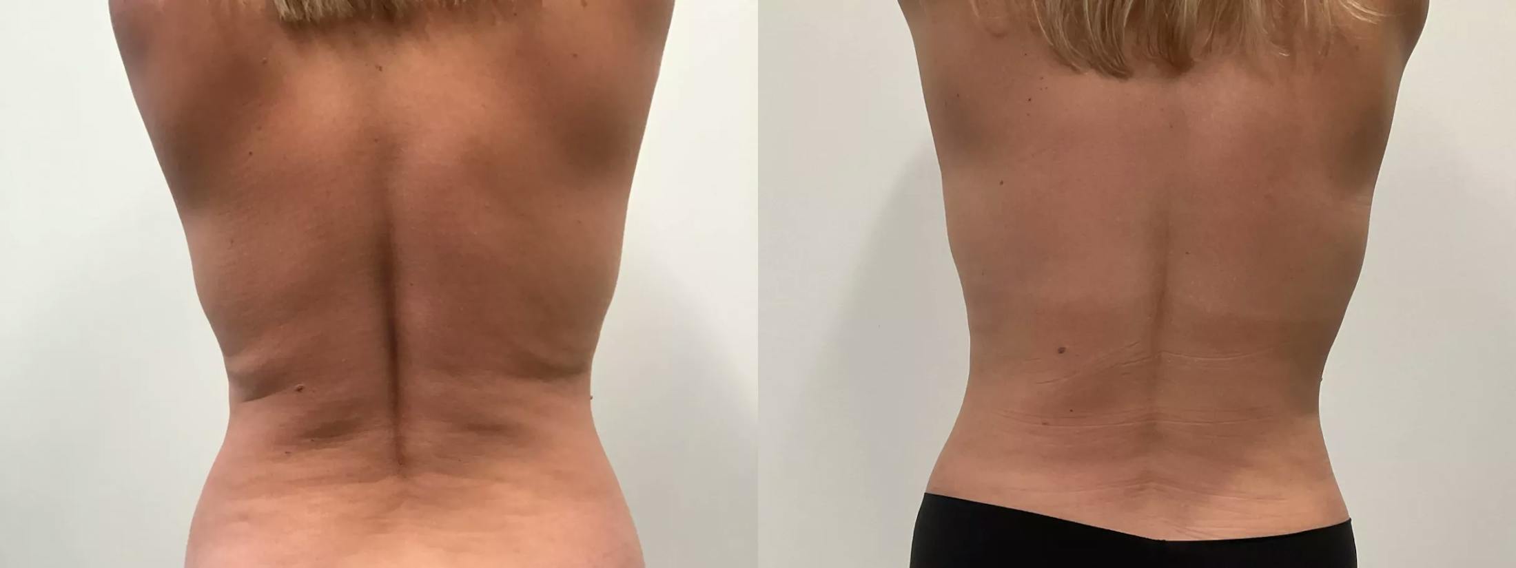 Liposuction Before & After Gallery - Patient 168451 - Image 4