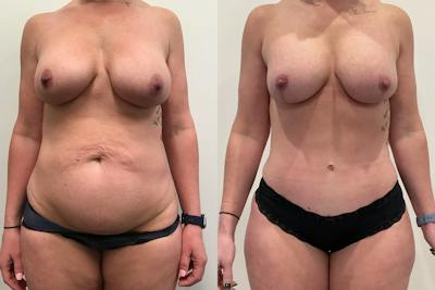 Mommy Makeover Before & After Gallery - Patient 373424 - Image 1