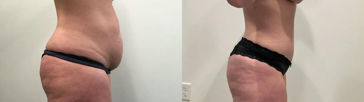 Mommy Makeover Before & After Gallery - Patient 373424 - Image 2