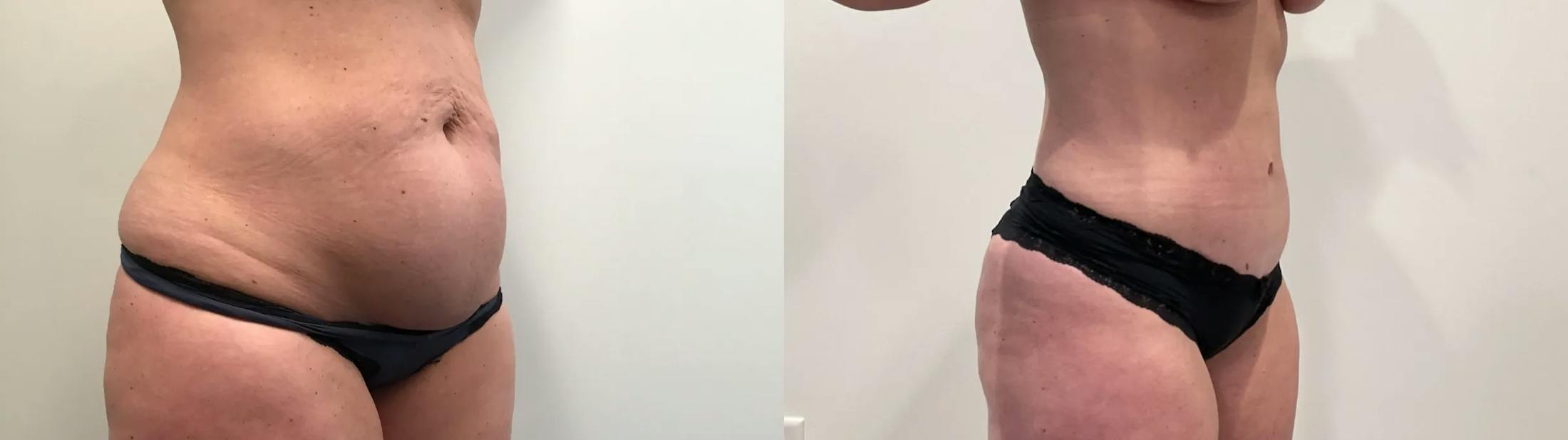 Mommy Makeover Before & After Gallery - Patient 373424 - Image 3