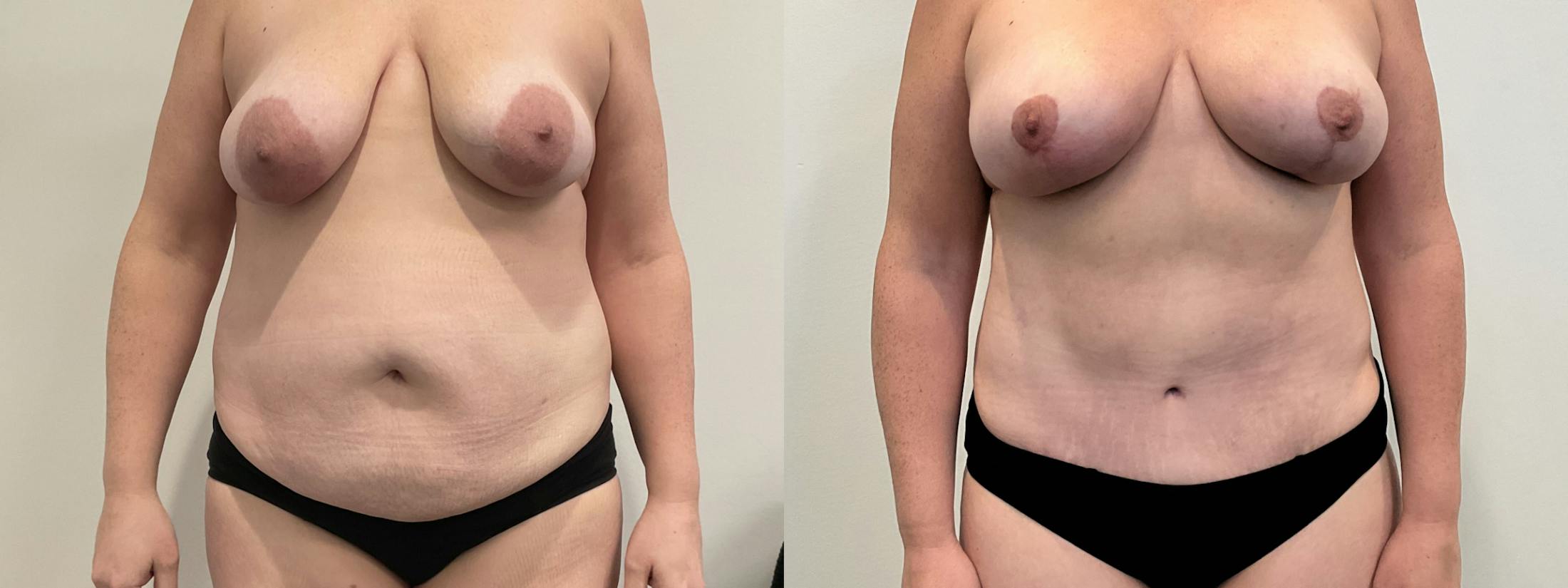 Mommy Makeover Before & After Gallery - Patient 235935 - Image 1