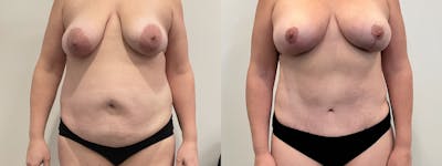 Mommy Makeover Before & After Gallery - Patient 235935 - Image 1
