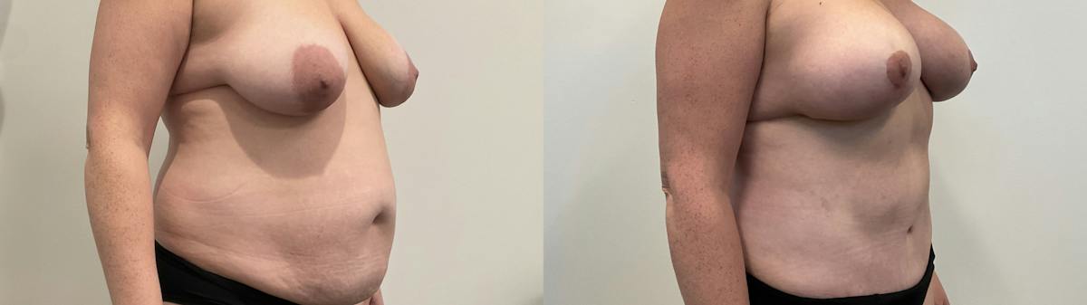Mommy Makeover Before & After Gallery - Patient 235935 - Image 2