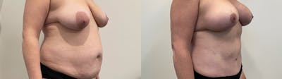 Mommy Makeover Before & After Gallery - Patient 235935 - Image 2