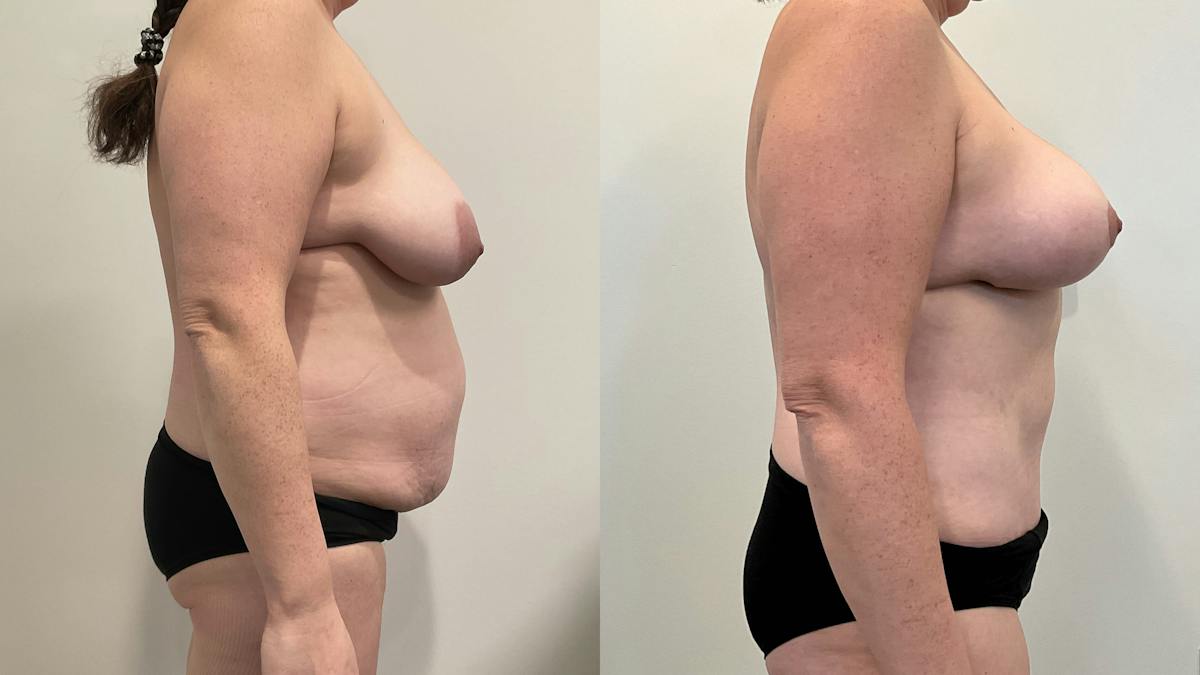 Mommy Makeover Before & After Gallery - Patient 235935 - Image 3