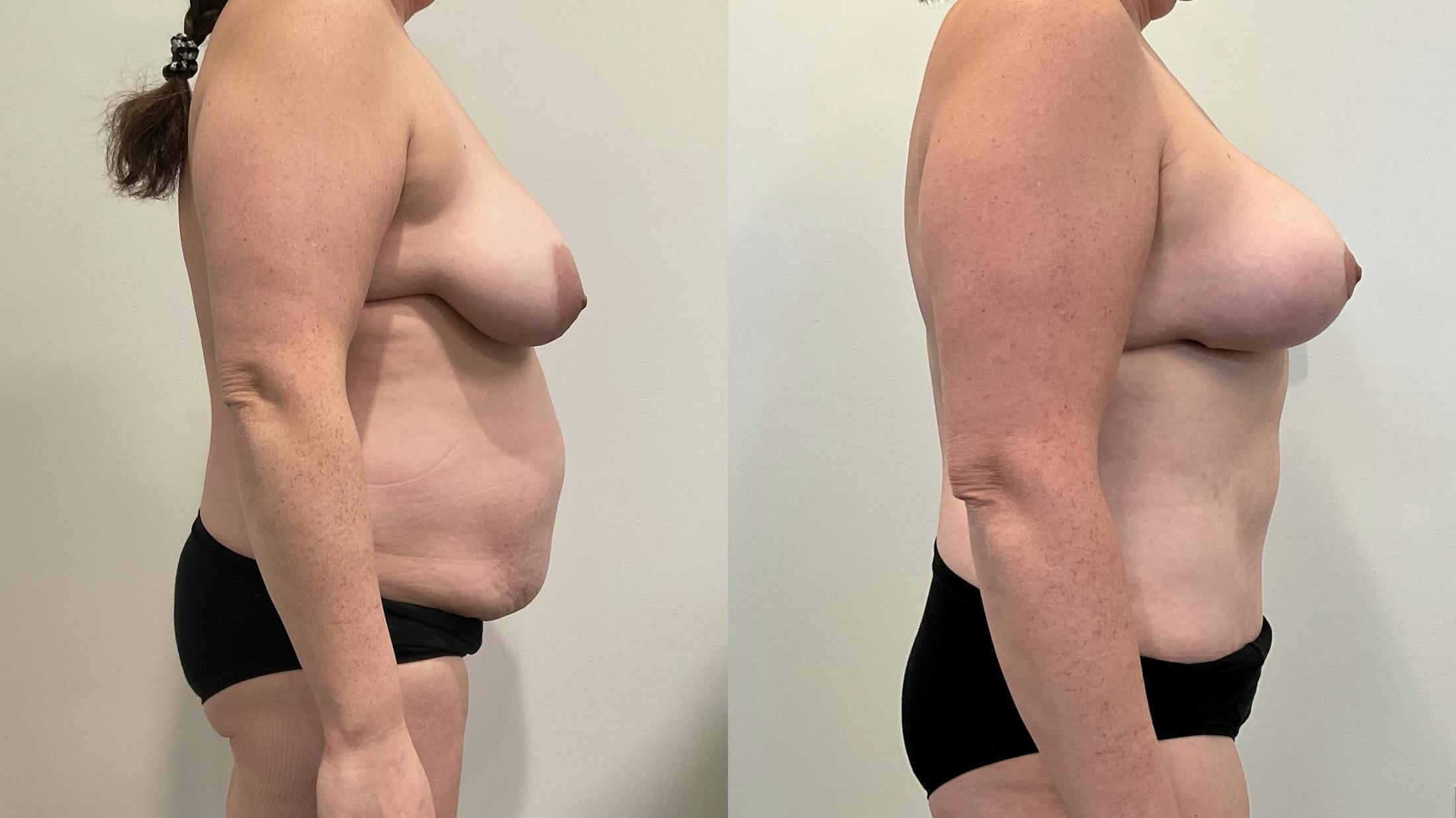 Mommy Makeover Before & After Gallery - Patient 235935 - Image 3