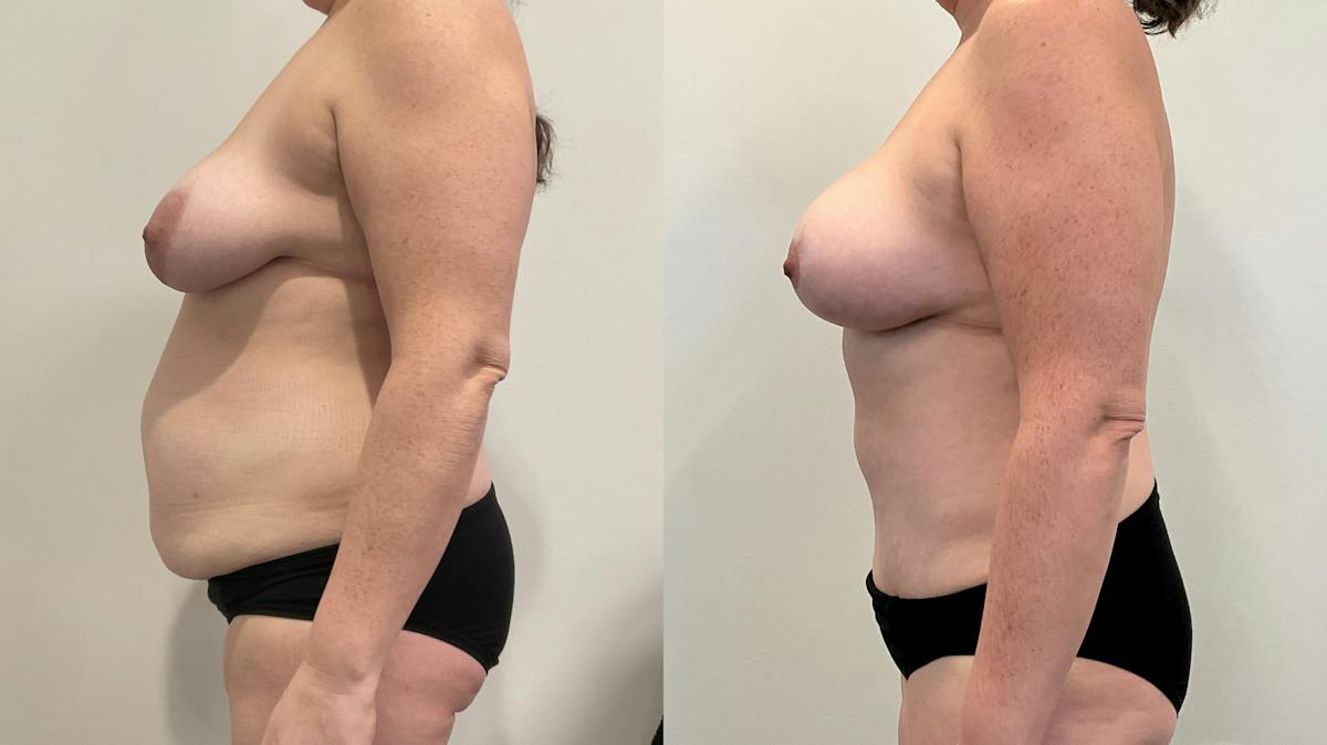 Mommy Makeover Before & After Gallery - Patient 235935 - Image 4