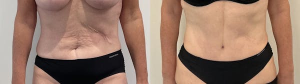 Tummy Tuck Before & After Gallery - Patient 181489 - Image 1