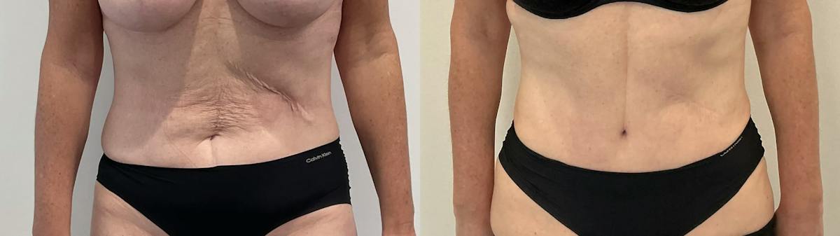Tummy Tuck Before & After Gallery - Patient 181489 - Image 1