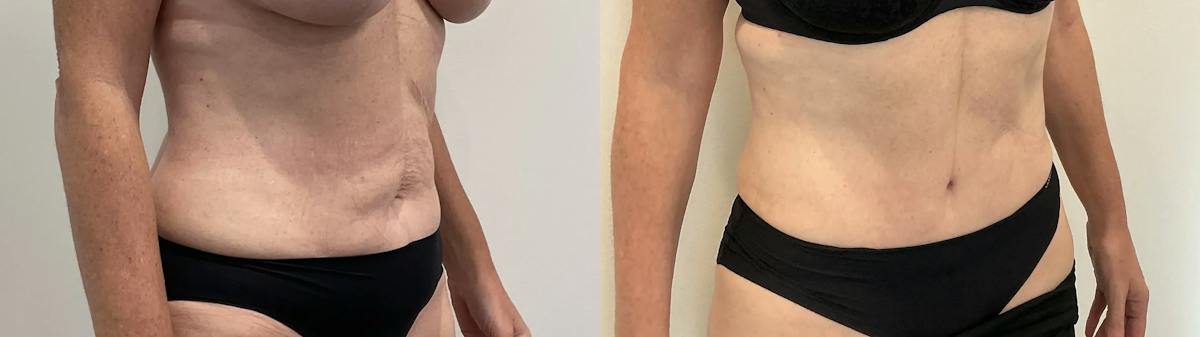 Tummy Tuck Before & After Gallery - Patient 181489 - Image 2