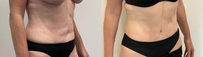 Tummy Tuck Before & After Gallery - Patient 181489 - Image 2