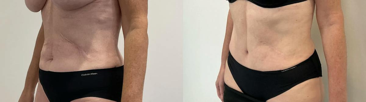 Tummy Tuck Before & After Gallery - Patient 181489 - Image 3