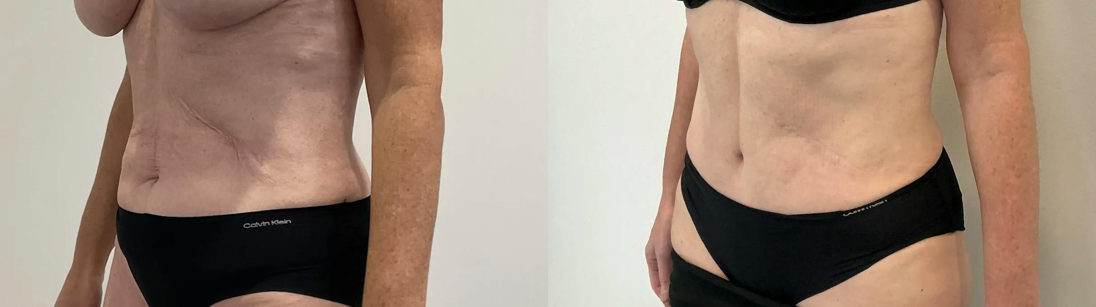 Tummy Tuck Before & After Gallery - Patient 181489 - Image 3