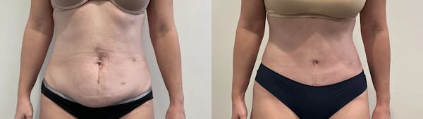 Tummy Tuck Before & After Gallery - Patient 502715 - Image 1