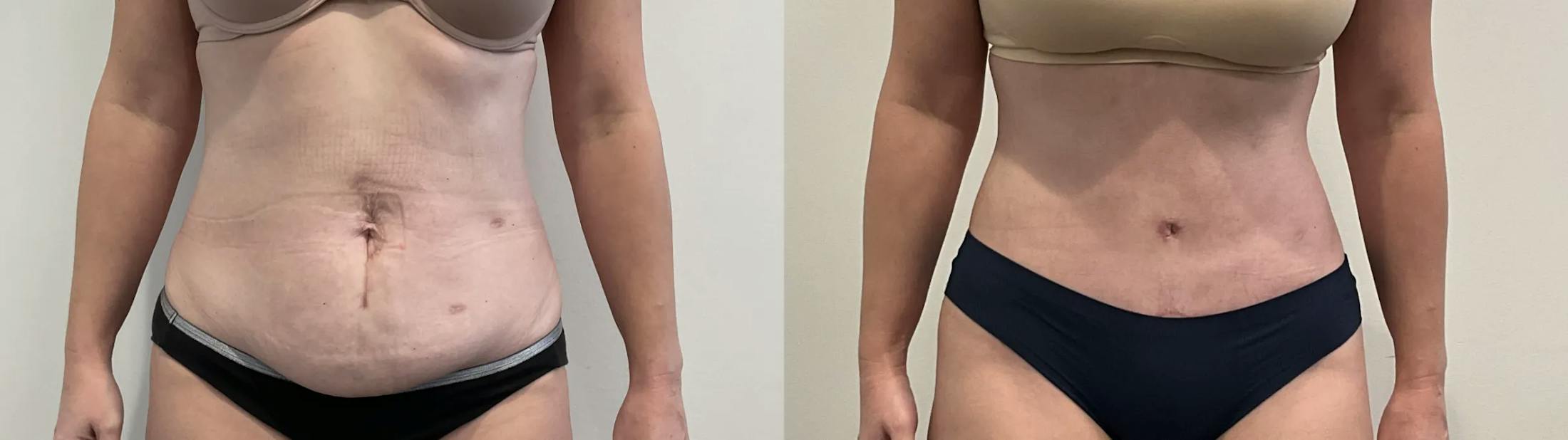 Tummy Tuck Before & After Gallery - Patient 502715 - Image 1