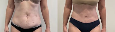 Tummy Tuck Before & After Gallery - Patient 502715 - Image 1