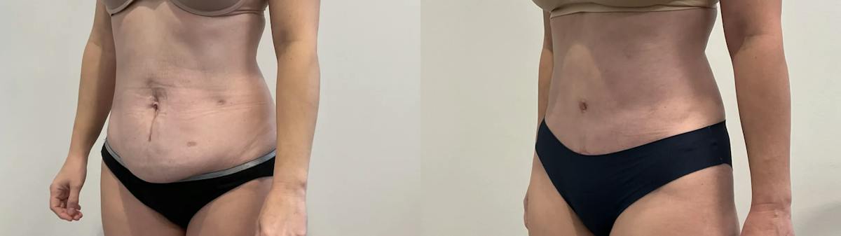 Tummy Tuck Before & After Gallery - Patient 502715 - Image 2