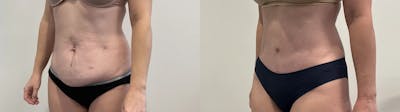 Tummy Tuck Before & After Gallery - Patient 502715 - Image 2