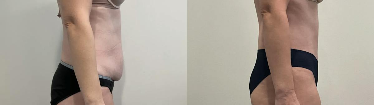 Tummy Tuck Before & After Gallery - Patient 502715 - Image 3