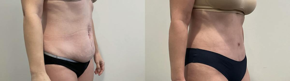 Tummy Tuck Before & After Gallery - Patient 502715 - Image 4