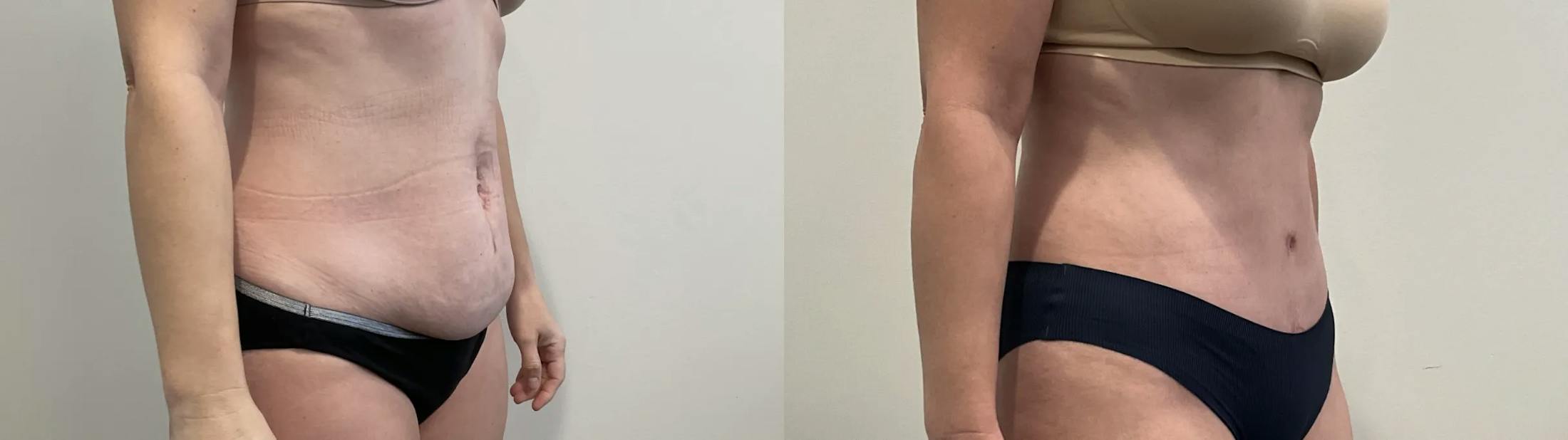 Tummy Tuck Before & After Gallery - Patient 502715 - Image 4