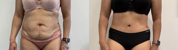Tummy Tuck Before & After Gallery - Patient 969552 - Image 1