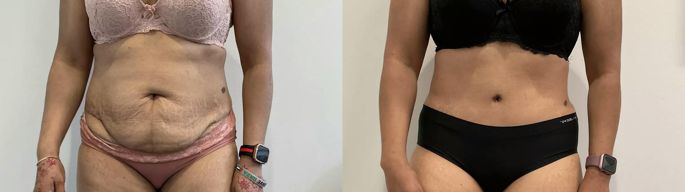 Tummy Tuck Before & After Gallery - Patient 969552 - Image 1