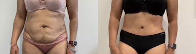 Tummy Tuck Before & After Gallery - Patient 969552 - Image 1