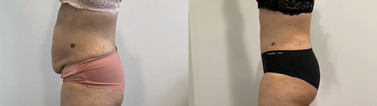 Tummy Tuck Before & After Gallery - Patient 969552 - Image 2