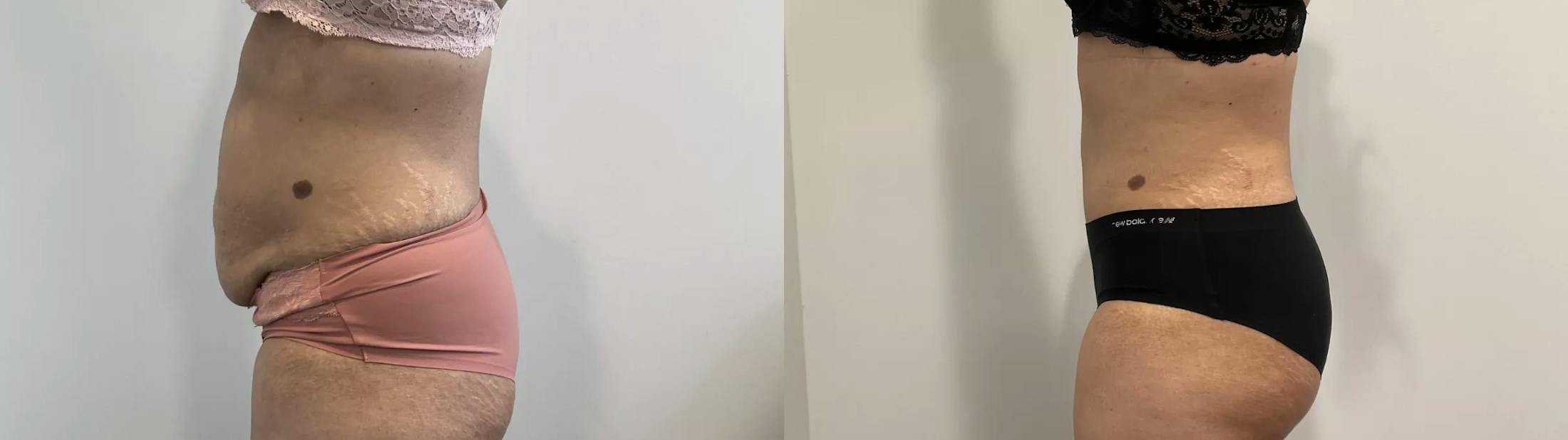 Tummy Tuck Before & After Gallery - Patient 969552 - Image 2