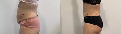 Tummy Tuck Before & After Gallery - Patient 969552 - Image 2