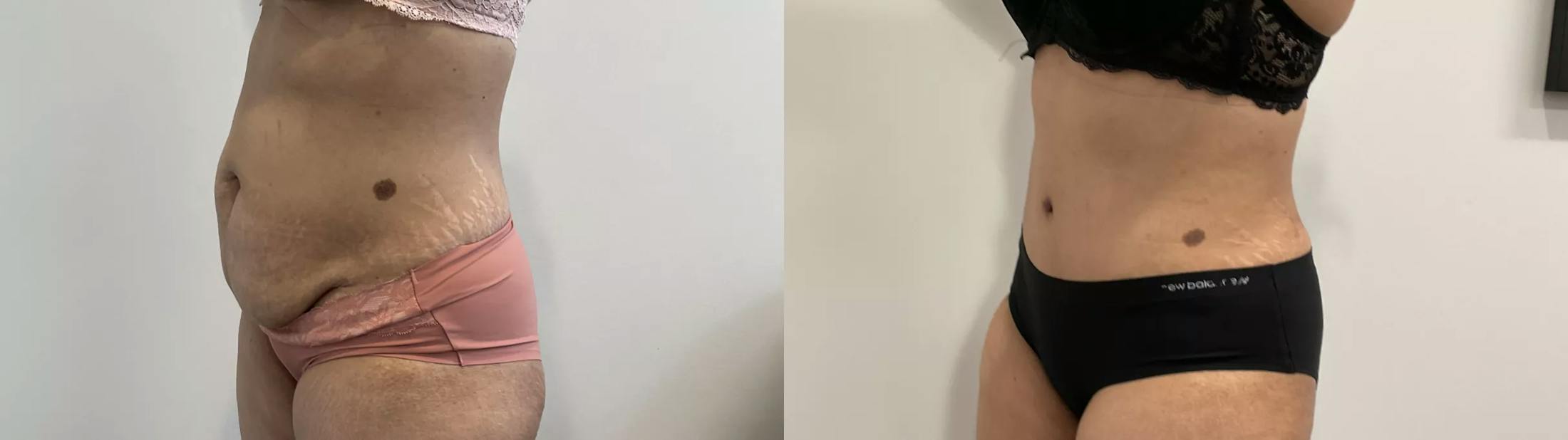 Tummy Tuck Before & After Gallery - Patient 969552 - Image 3