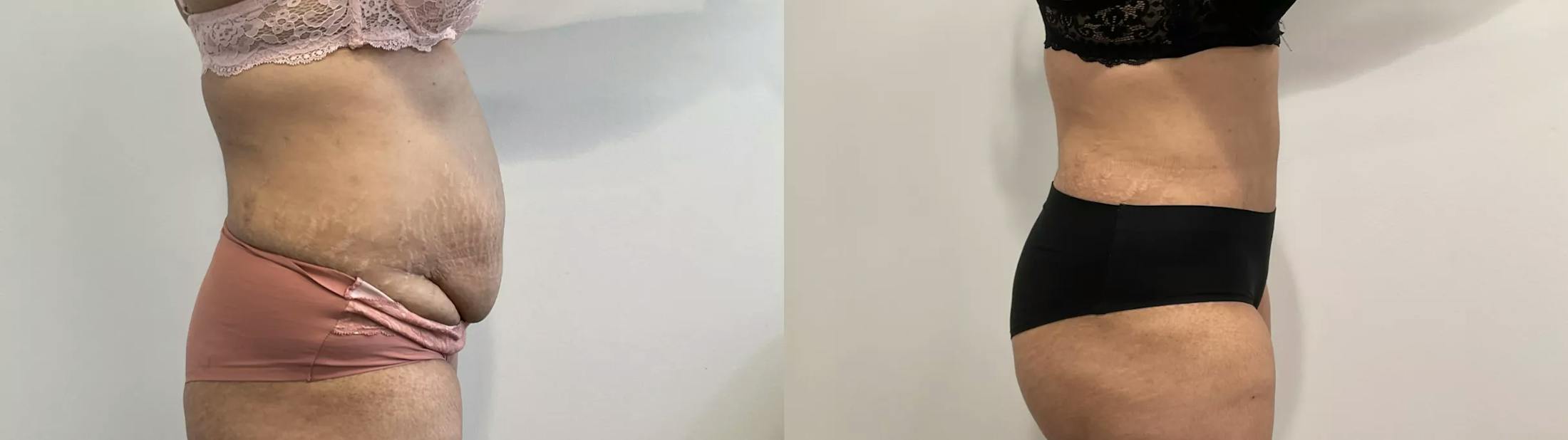 Tummy Tuck Before & After Gallery - Patient 969552 - Image 4