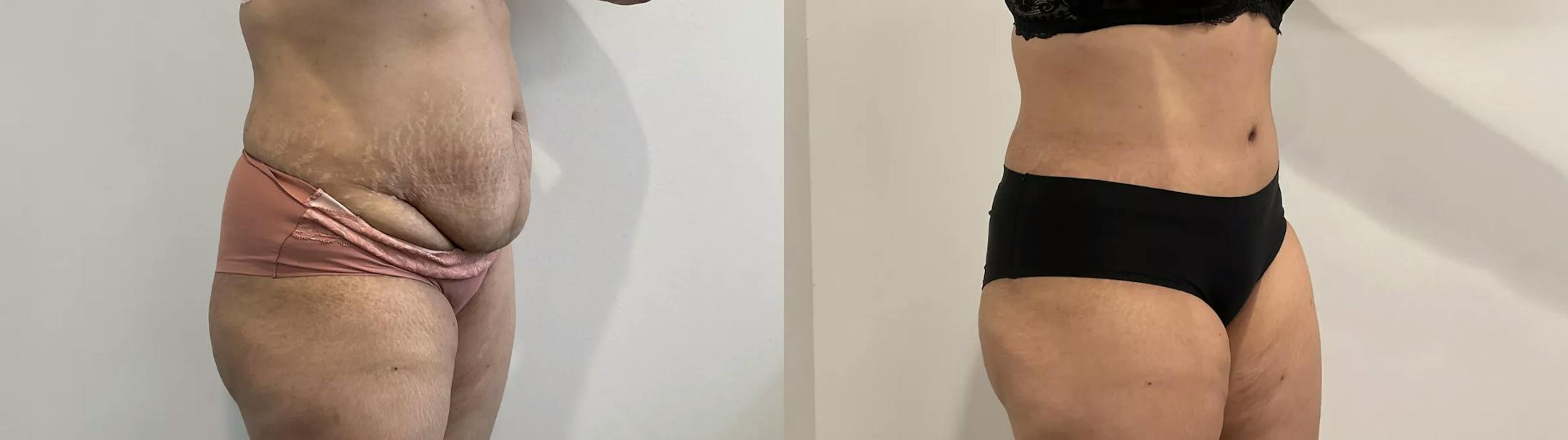 Tummy Tuck Before & After Gallery - Patient 969552 - Image 5