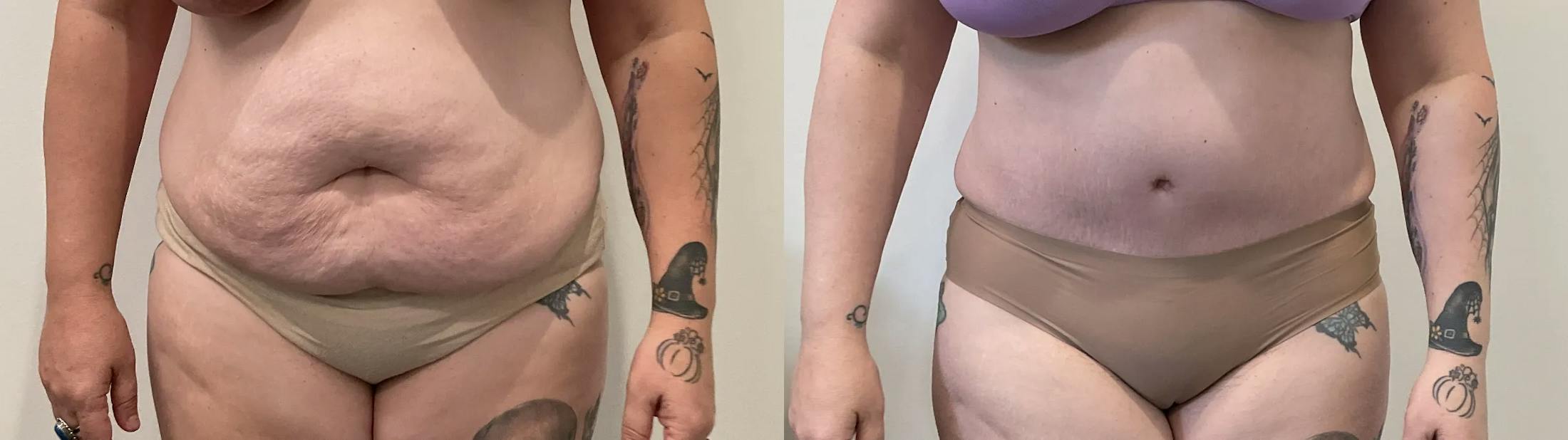 Tummy Tuck Before & After Gallery - Patient 817430 - Image 1