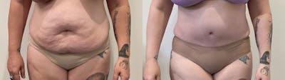 Tummy Tuck Before & After Gallery - Patient 817430 - Image 1