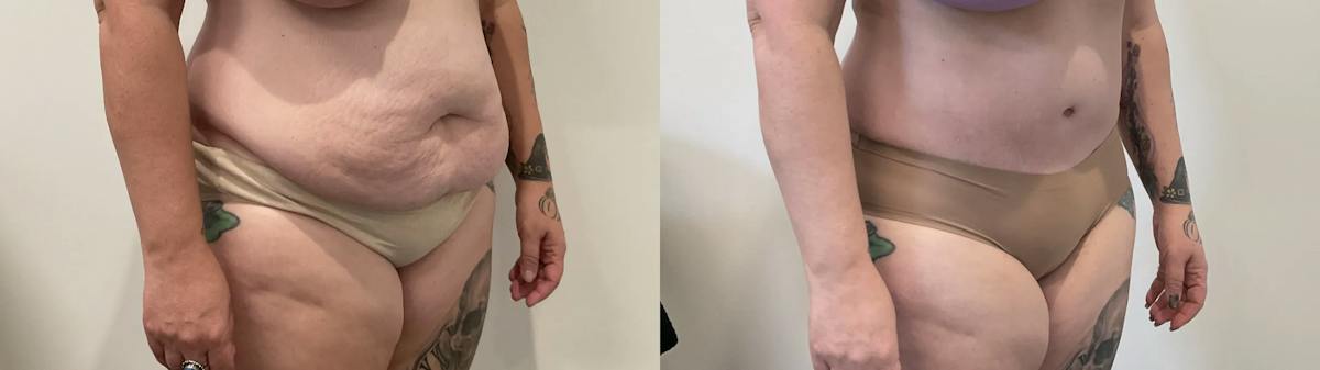 Tummy Tuck Before & After Gallery - Patient 817430 - Image 2