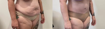 Tummy Tuck Before & After Gallery - Patient 817430 - Image 2