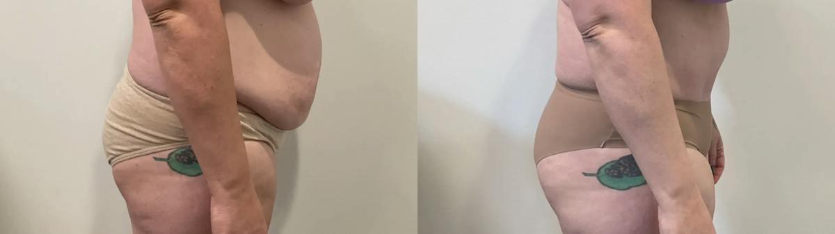 Tummy Tuck Before & After Gallery - Patient 817430 - Image 3