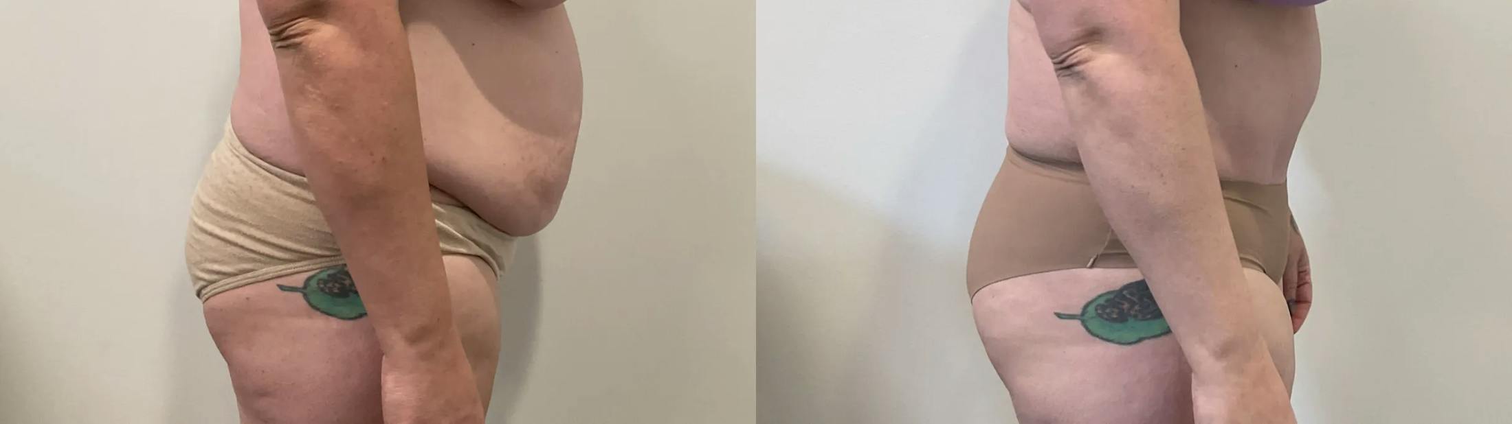 Tummy Tuck Before & After Gallery - Patient 817430 - Image 3