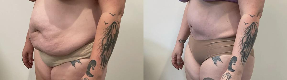 Tummy Tuck Before & After Gallery - Patient 817430 - Image 4