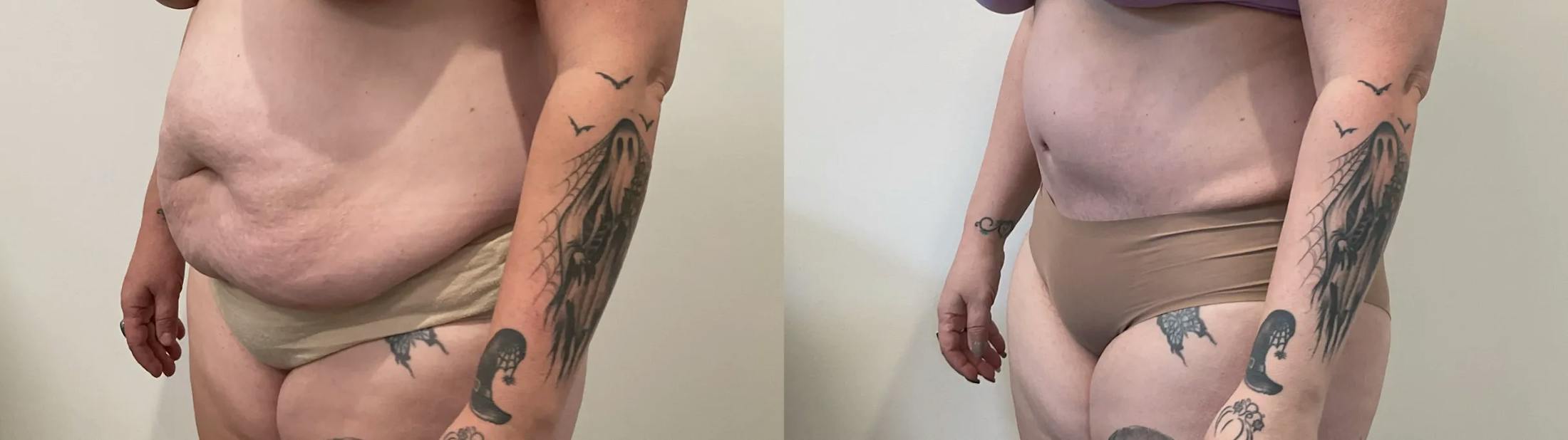 Tummy Tuck Before & After Gallery - Patient 817430 - Image 4